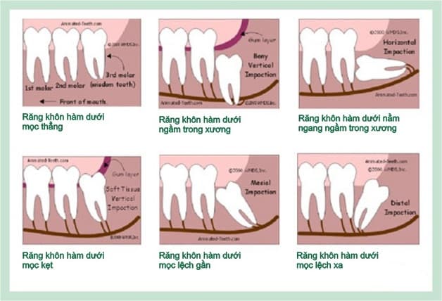 Có nên nhổ răng khôn không còn phụ thuộc vào từng tình trạng mọc răng khôn cụ thể