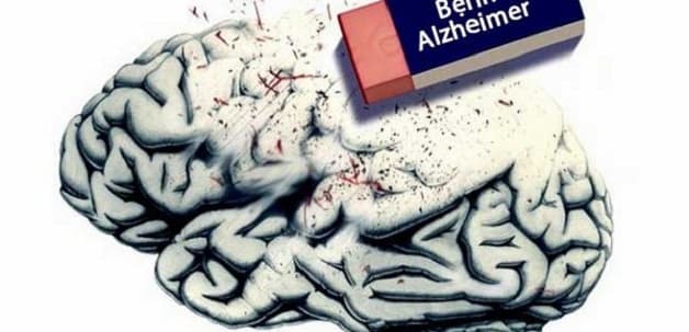 biểu hiện của bệnh alzheimer ở giai đoạn cuối 