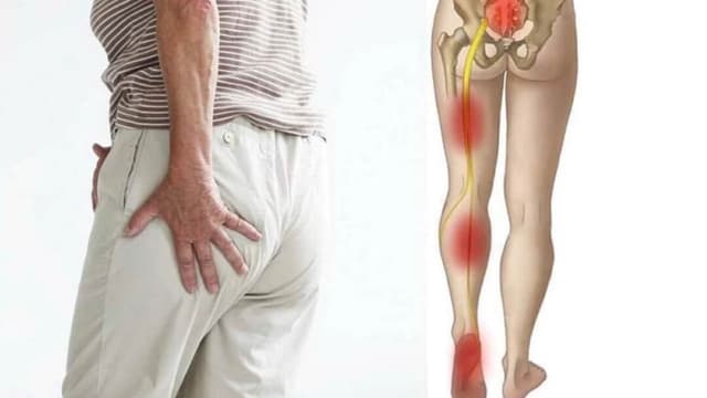 Đau thần kinh tọa điều trị như thế nào?
