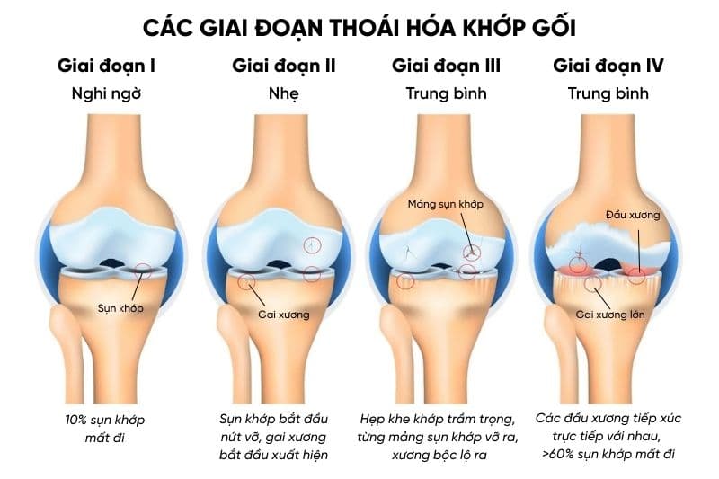 bệnh viêm thoái hóa khớp gối nguy hiểm như thế nào