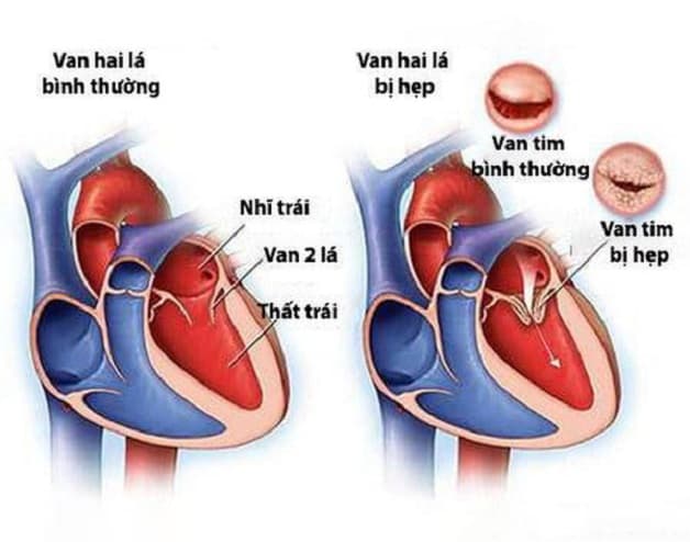 Bệnh hẹp van hai lá không thể chữa khỏi hoàn toàn nhưng có thể điều trị nhằm giảm triệu chứng và phòng ngừa biến chứng.
