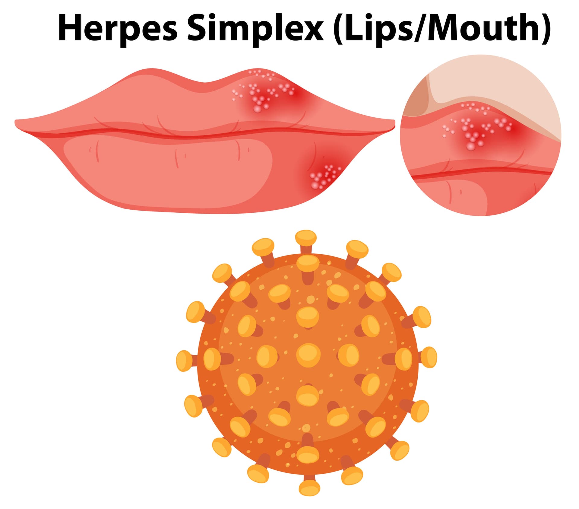 Hình ảnh mụn rộp sinh dục: bệnh được gây ra bởi virus herpes và lây nhiễm qua đường tình dục