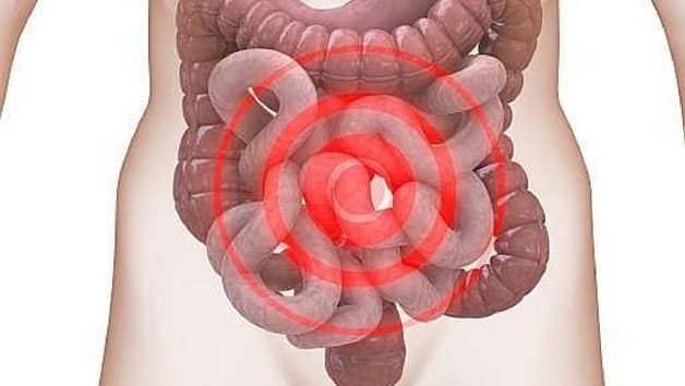 Hội chứng ruột bị kích thích là gì?