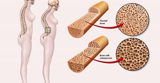 nữ giới loãng xương