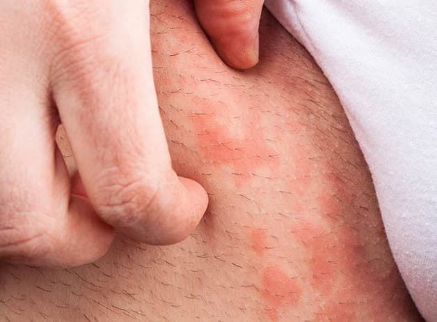 Bị ngứa vùng háng ở nam cũng có thể là triệu chứng của viêm nang lông