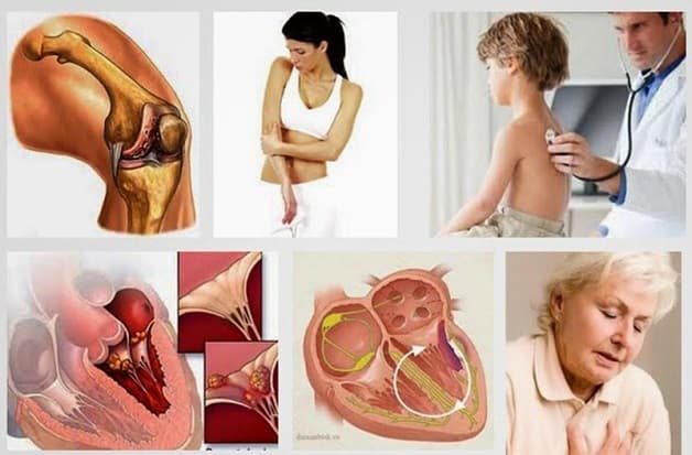 Bệnh thấp tim thực chất là một bệnh tự miễn do các kháng thể do cơ thể sản sinh ra để chống lại các liên cầu khuẩn nhóm A tấn công nhầm vào khớp, cơ tim, van tim,...