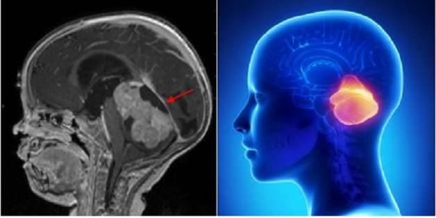 nguyên nhân gây viêm dây thần kinh số 5 