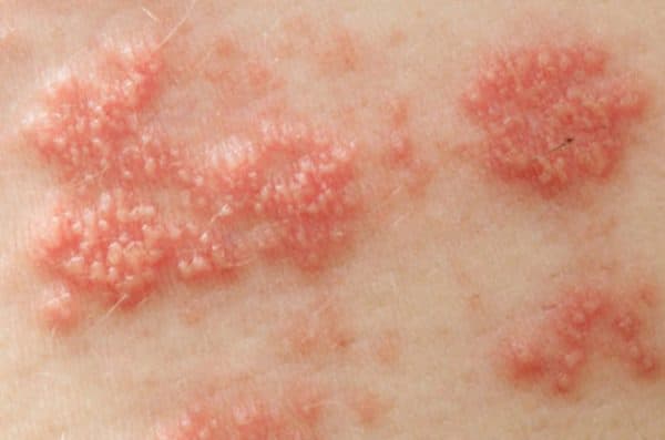 Nổi mẩn đỏ ngứa ở háng nam giới thường xuất hiện với những biểu hiện ban đầu là các nốt ban, mụn nước gây ngứa, khi gãi mạnh thì vùng ngứa càng có dấu hiệu lan rộng