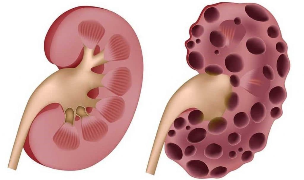 Sỏi tiết niệu có thể gây hỏng thận nếu không kịp thời điều trị biến chứng