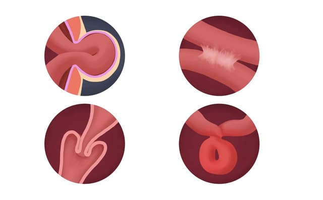 Tắc ruột non được phát hiện và điều trị như thế nào?