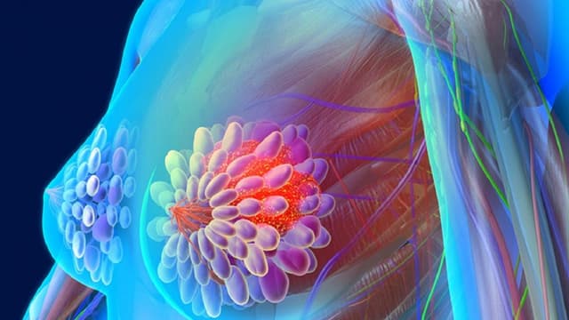 Tuyến vú tăng sản là gì? Nguyên nhân và cách phòng ngừa