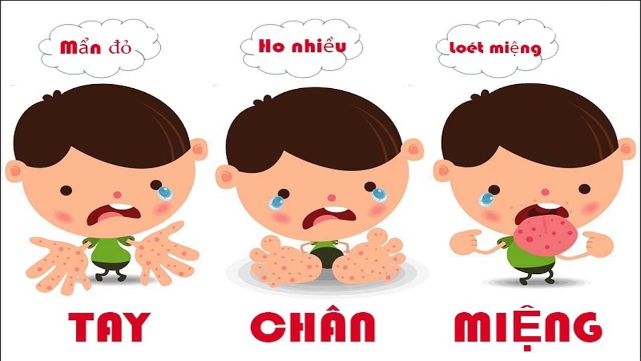 Bệnh tay chân miệng là bệnh lý phổ biến ở trẻ , thường xuất hiện vào thời điểm giao mùa