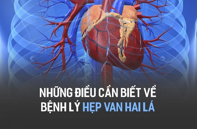 Hẹp van hai lá là một trong những bệnh lý van tim phổ biến nhất.