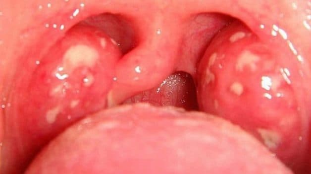 Viêm Amidan hốc mủ là gì