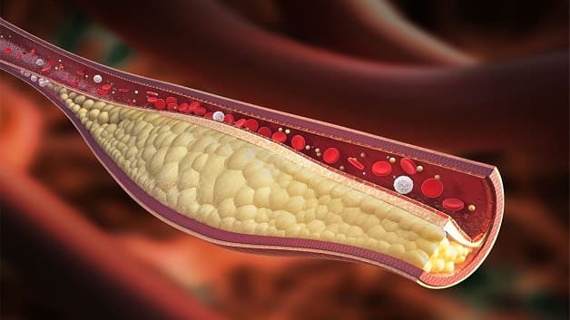 Xơ vữa động mạch là tình trạng tích tụ cholesterol, canxi trên thành động mạch, khiến máu chảy qua khó khăn do lòng mạch bị thu hẹp.