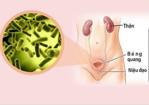 Vi khuẩn E.coli là nguyên nhân hàng đầu gây viêm tiết niệu cấp hiện nay.