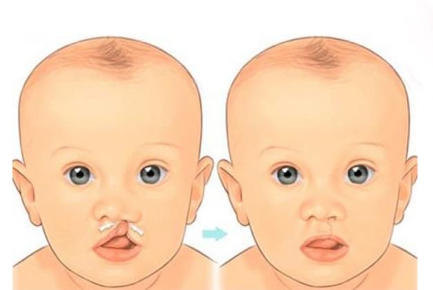 Sứt môi hở hàm ếch