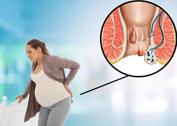 Bệnh trĩ khi mang thai là gì?