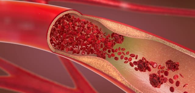 Bệnh tim thiếu máu cục bộ: Đặc điểm và cách điều trị