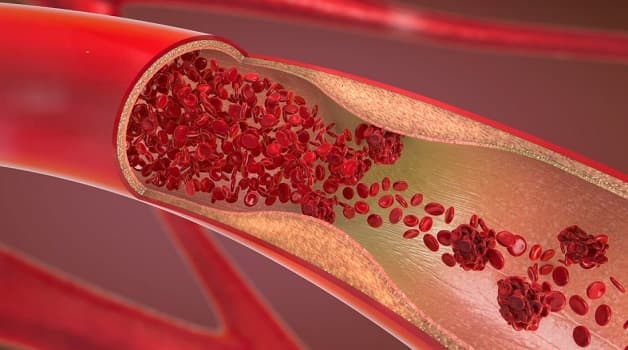 Tim bị gián đoạn hoặc hạn chế cũng cấp máu và oxy khiến hoạt động của hệ tuần hoàn và cả cơ thể bị ảnh hưởng.