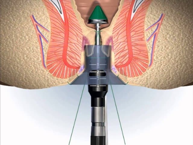 Phương pháp cắt trĩ Longo giúp bệnh nhân bớt đau hiệu quả