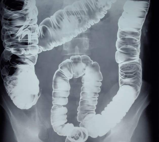 Chụp X quang đại tràng có cản quang