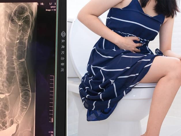 Chụp X quang đại tràng phát hiện nhiều bệnh