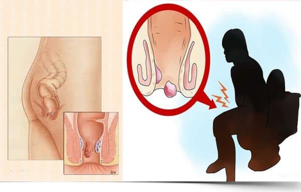 Ngồi đúng tư thế khi đi vệ sinh