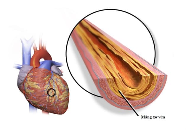 Nhồi máu cơ tim bệnh học với yếu tố nguyên nhân