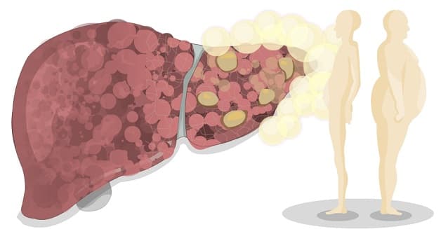 Gan nhiễm mỡ là nguyên nhân men gan cao thường gặp