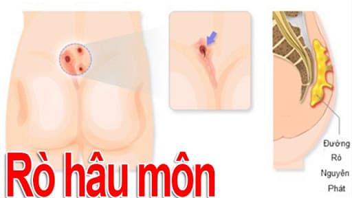 Nguyên nhân gây rò hậu môn bao gồm các yếu tố bên trong và bên ngoài tác động