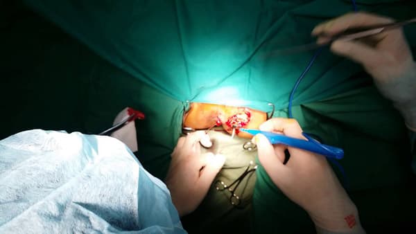 Nguyên nhân rò hậu môn ảnh hưởng