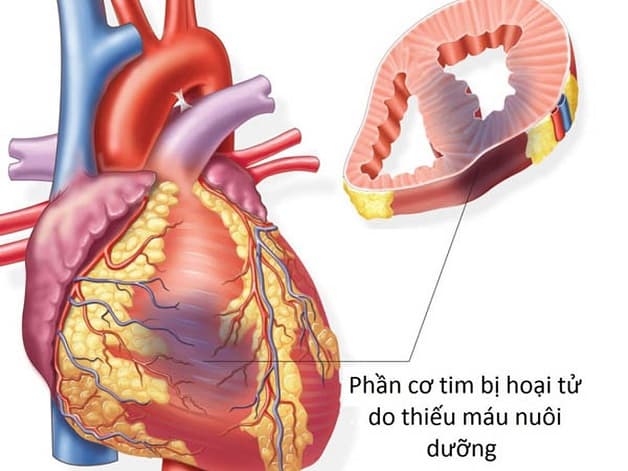 Nhồi máu cơ tim thành dưới là hiện tượng tắc nghẽn động mạch vành phải và động mạch vành mũ
