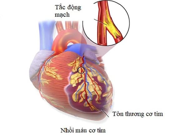 Nhồi máu cơ tim type 1 là loại phổ biến nhất trong 5 type nhồi máu cơ tim hiện nay.