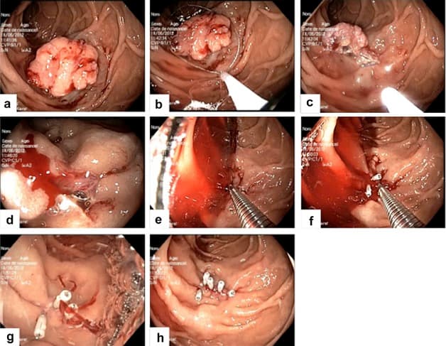 Phương pháp nội soi bao tử