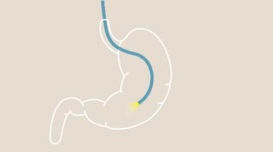 3 phương pháp nội soi bao tử phổ biến hiện nay