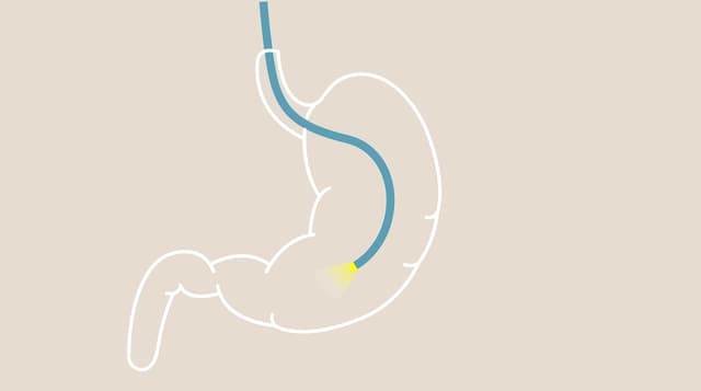 3 phương pháp nội soi bao tử phổ biến hiện nay