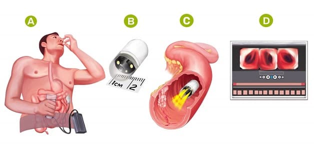 Nội soi ruột non bằng viên nang