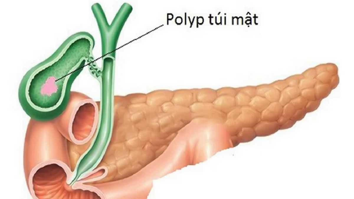 Cách xử trí khi mắc polyp túi mật 8mm