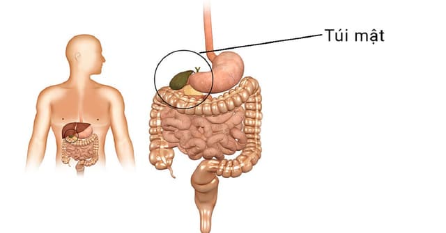 Polyp túi mật và cách điều trị hiệu quả