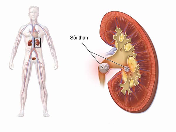 Sỏi thận tiểu ra máu rất nguy hiểm