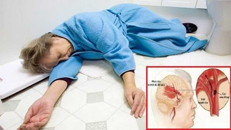 Người bị tai biến mạch máu não hay đột quỵ não cần được cấp cứu càng sớm càng tốt