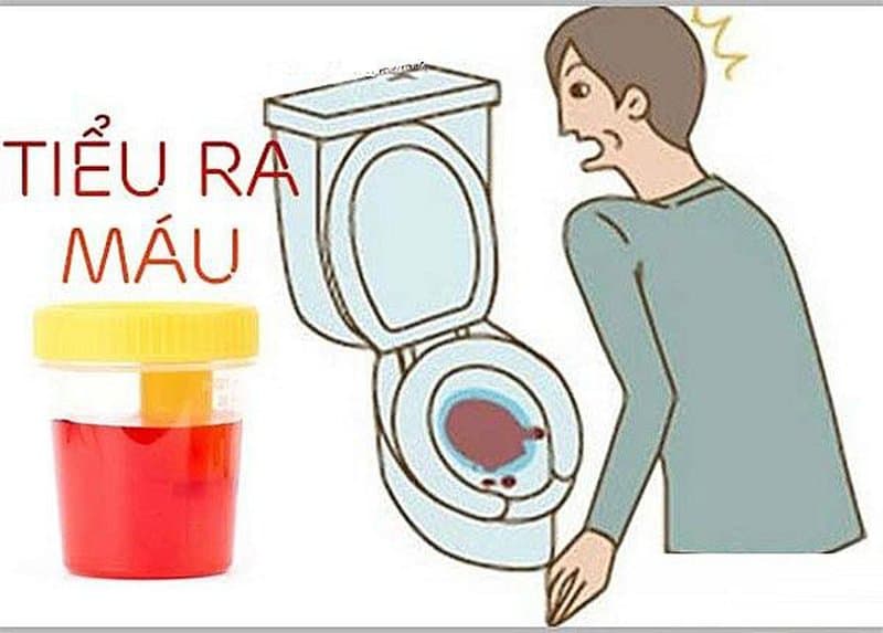 Ngoài cơn đau quặn thận thì triệu chứng bệnh sỏi thận phổ biến là các vấn đề đường tiểu