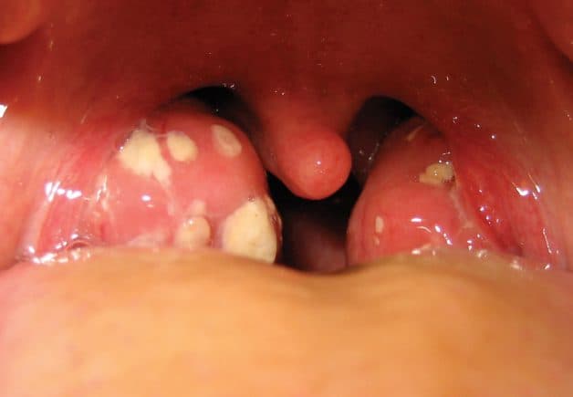 Khi các tác nhân gây hại xâm nhập ồ ạt vào nhưng tổ chức Amidan không phản ứng kịp thì hiện tượng viêm Amidan sẽ xảy ra