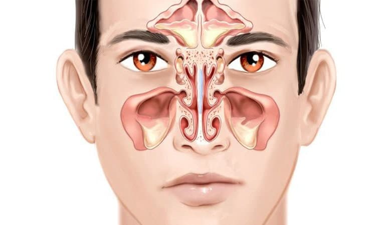 Bệnh viêm đa xoang 