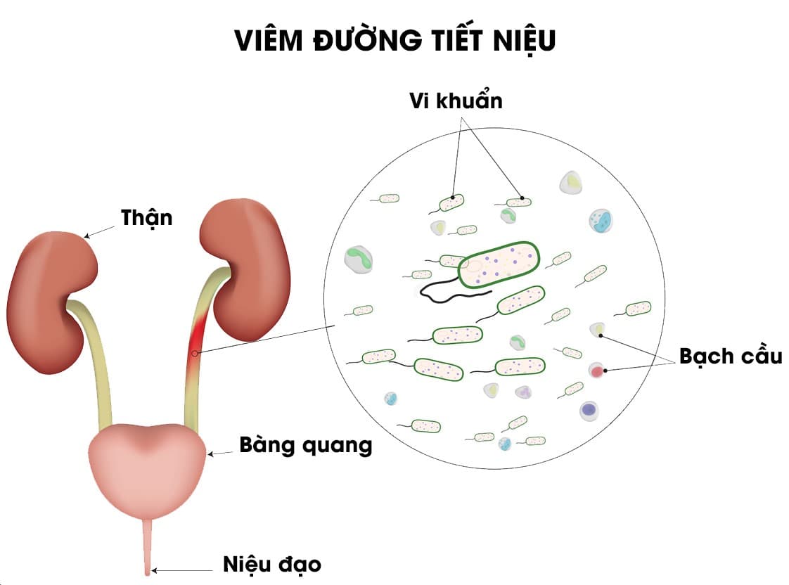 Viêm đường tiết niệu làm sao hết cần tìm hiểu