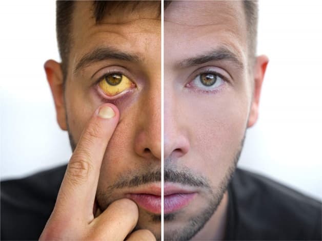 Triệu chứng viêm gan B là gì?