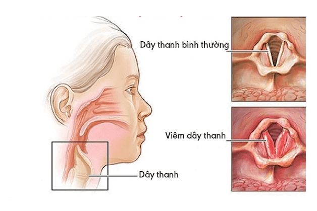 Khi tiếp xúc với những tác nhân gây bệnh như khói bụi, vi khuẩn, virus... thanh quản sẽ bị nhiễm trùng.