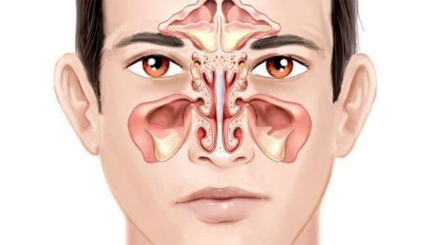 Viêm xoang cấp tính là gì