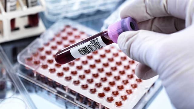 Xét nghiệm nhồi máu cơ tim gồm những gì, khi nào cần làm?